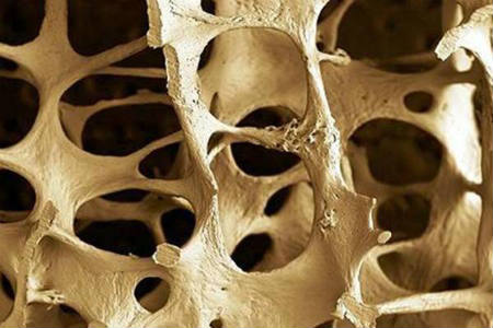 Síntamos de la osteoporosis