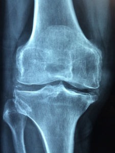 Tratamiento de la osteoporosis